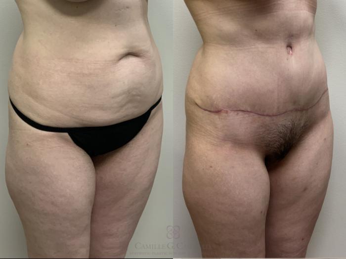 Before & After Tummy Tuck Case 689 Right Oblique View in Houston, TX