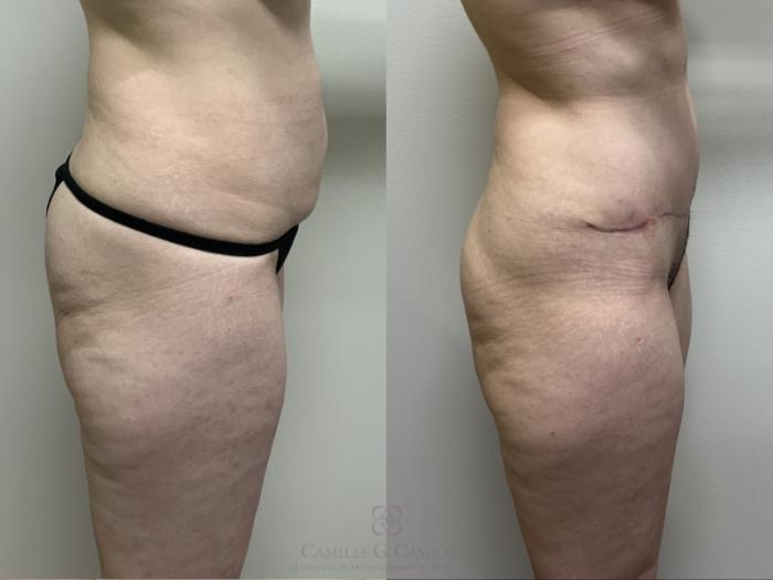 Before & After Tummy Tuck Case 689 Right Side View in Houston, TX