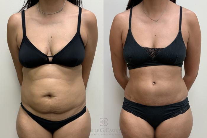 Before & After Tummy Tuck Case 693 Front View in Houston, TX