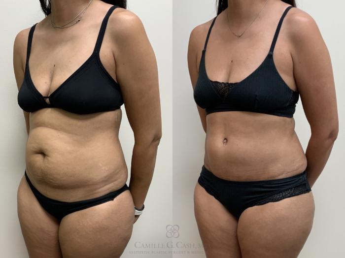 Before & After Tummy Tuck Case 693 Left Oblique View in Houston, TX