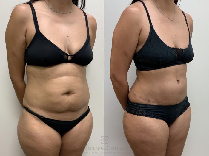 Before & After Tummy Tuck Case 693 Right Oblique View in Houston, TX