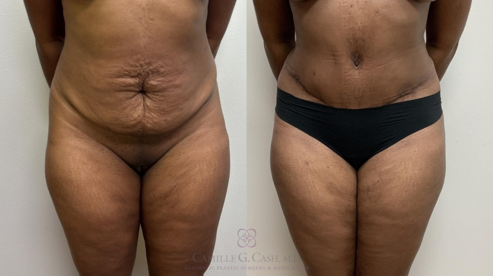 Before & After Tummy Tuck Case 697 Front View in Houston, TX