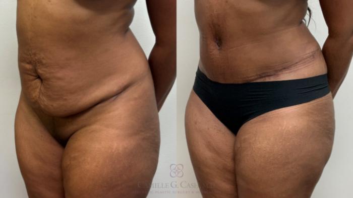 Before & After Tummy Tuck Case 697 Left Oblique View in Houston, TX