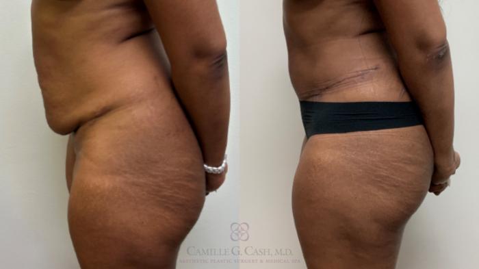 Before & After Tummy Tuck Case 697 Left Side View in Houston, TX