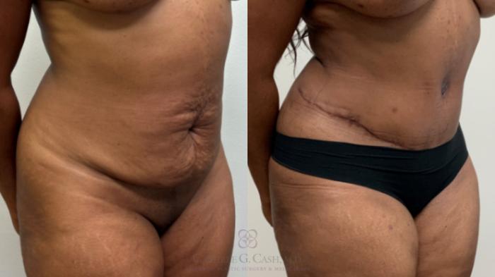 Before & After Tummy Tuck Case 697 Right Oblique View in Houston, TX