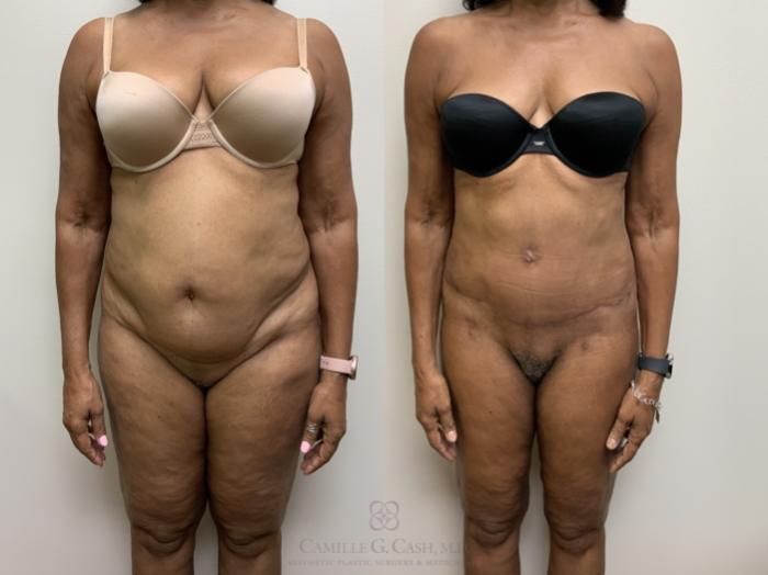 Before & After Tummy Tuck Case 704 Front View in Houston, TX