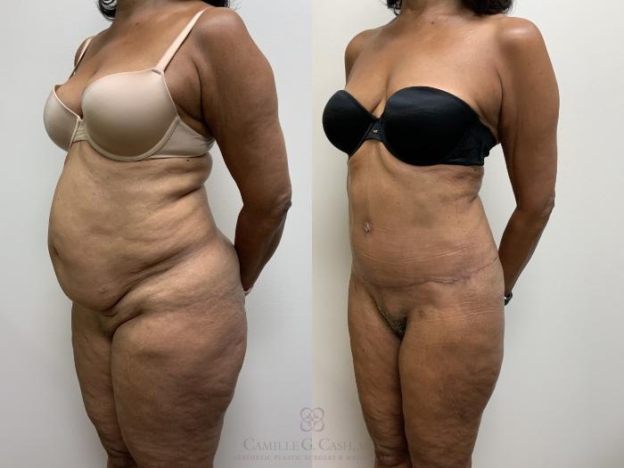 Before & After Tummy Tuck Case 704 Left Oblique View in Houston, TX