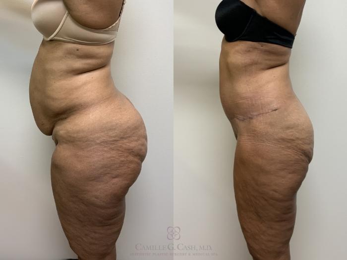 Before & After Tummy Tuck Case 704 Left Side View in Houston, TX