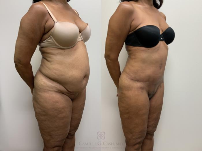 Before & After Tummy Tuck Case 704 Right Oblique View in Houston, TX