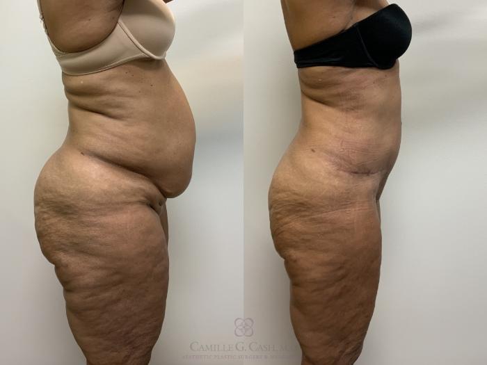 Before & After Tummy Tuck Case 704 Right Side View in Houston, TX