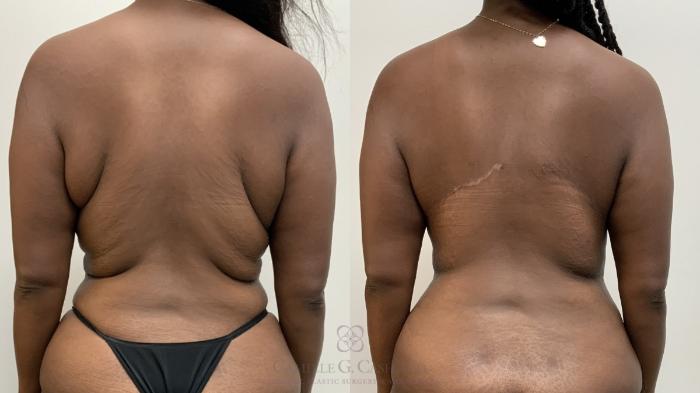 Before & After Tummy Tuck Case 709 Back View in Houston, TX