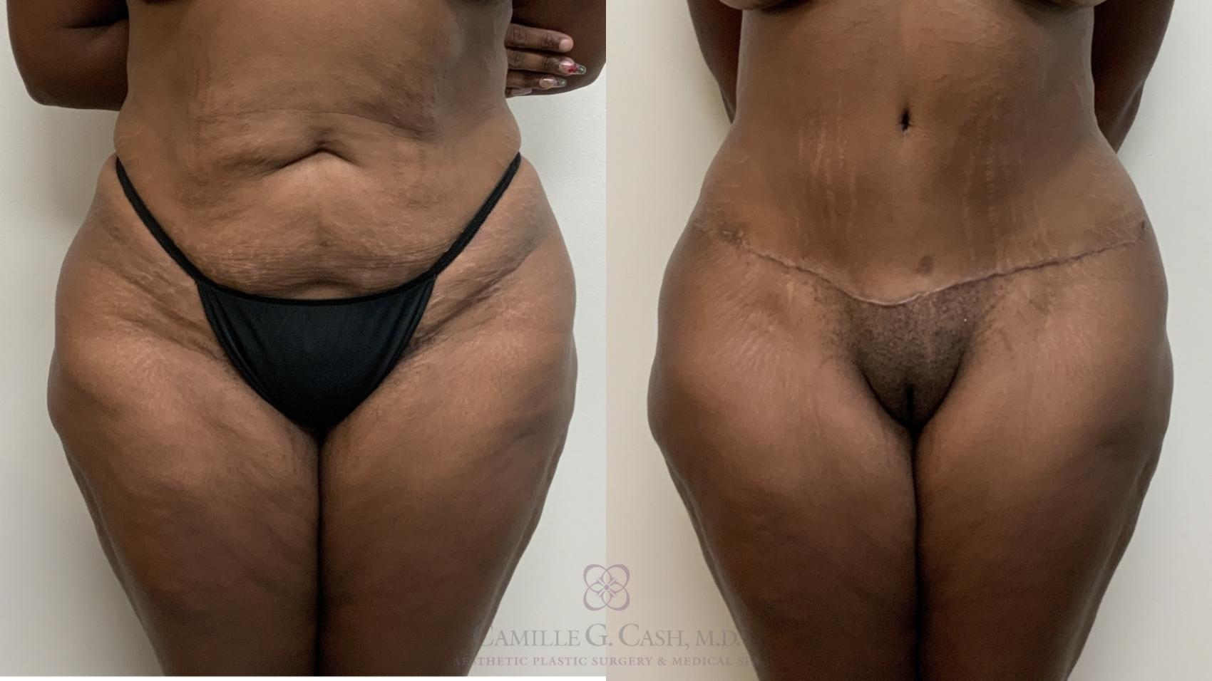 Before & After Tummy Tuck Case 709 Front View in Houston, TX