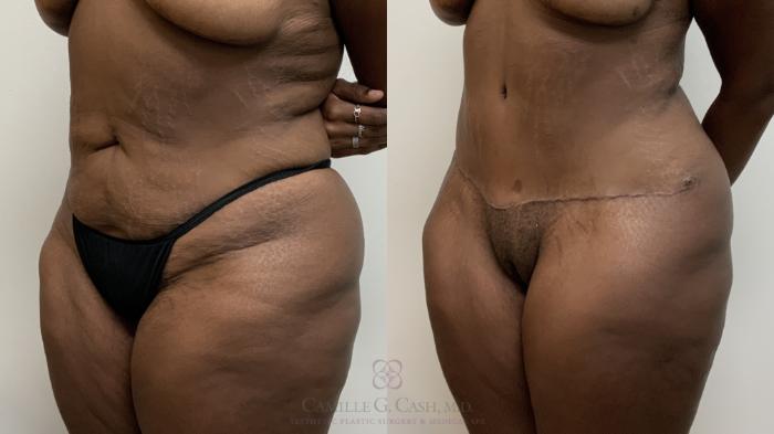 Before & After Tummy Tuck Case 709 Left Oblique View in Houston, TX