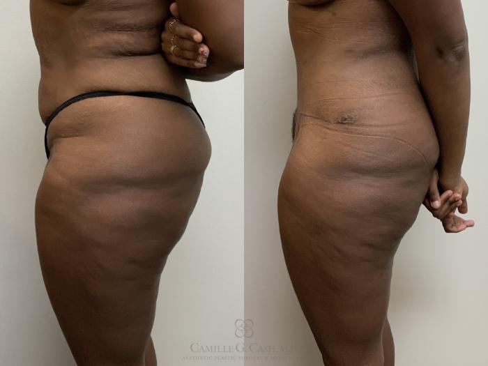 Before & After Tummy Tuck Case 709 Left Side View in Houston, TX