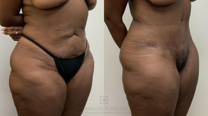 Before & After Tummy Tuck Case 709 Right Oblique View in Houston, TX