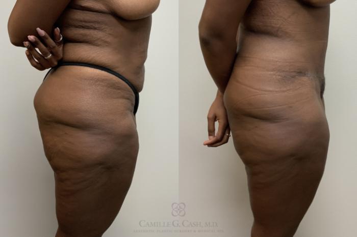 Before & After Tummy Tuck Case 709 Right Side View in Houston, TX