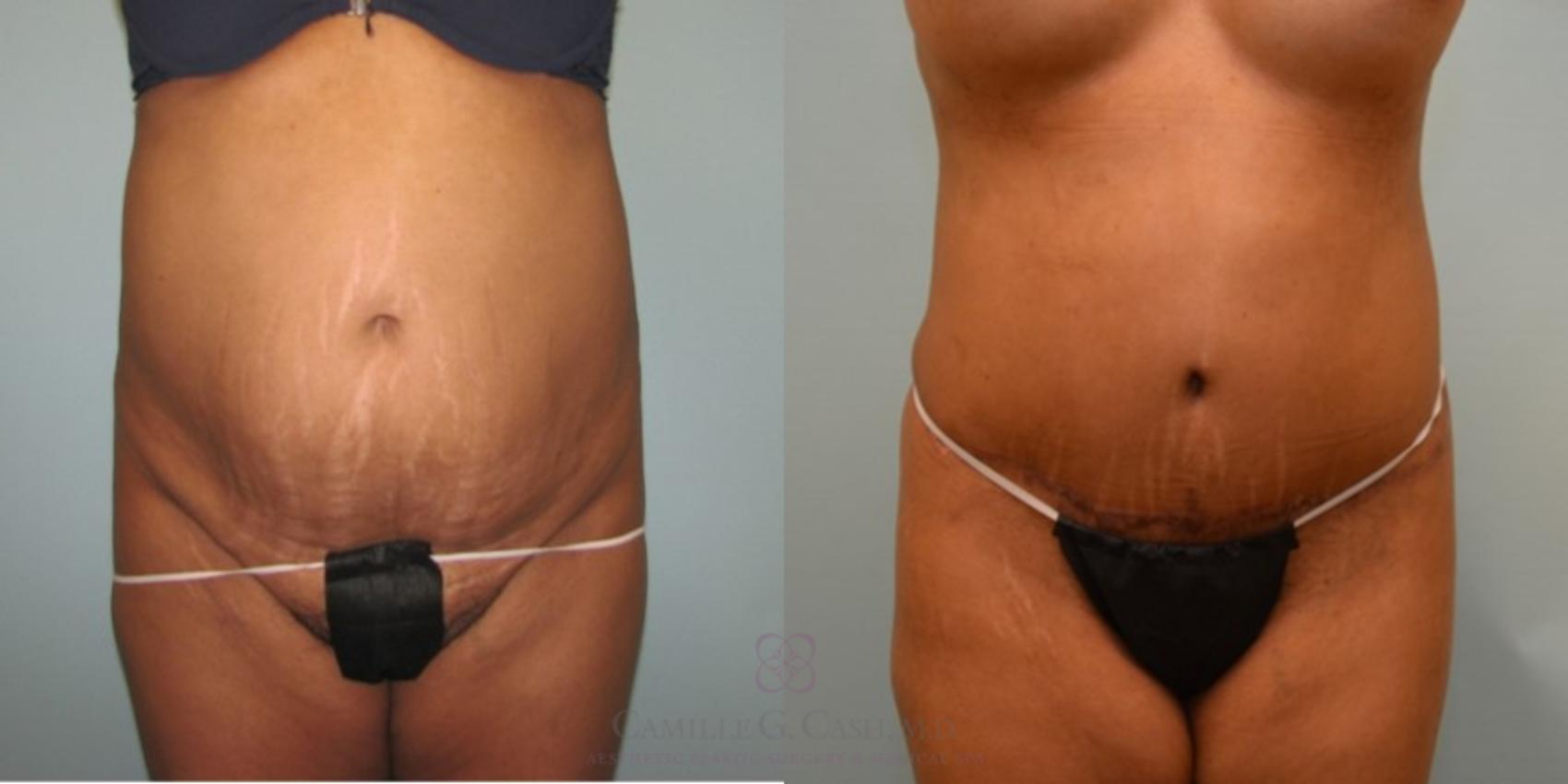 Before & After Tummy Tuck Case 71 View #1 View in Houston, TX