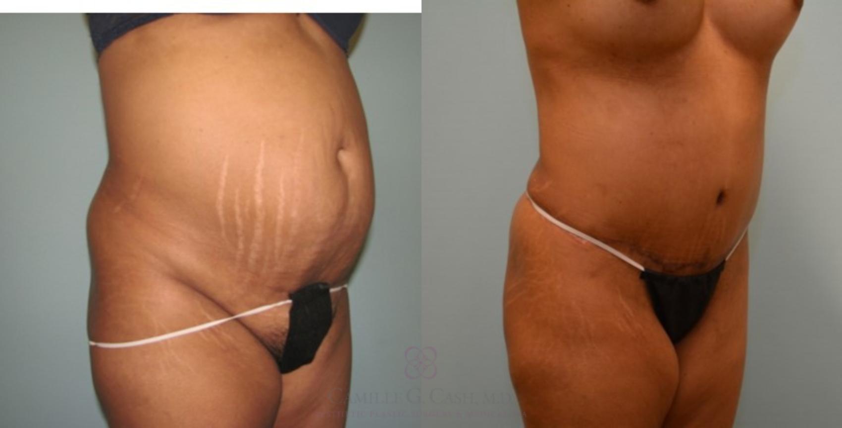 Before & After Tummy Tuck Case 71 View #2 View in Houston, TX