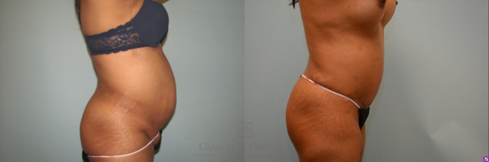 Before & After Tummy Tuck Case 71 View #3 View in Houston, TX