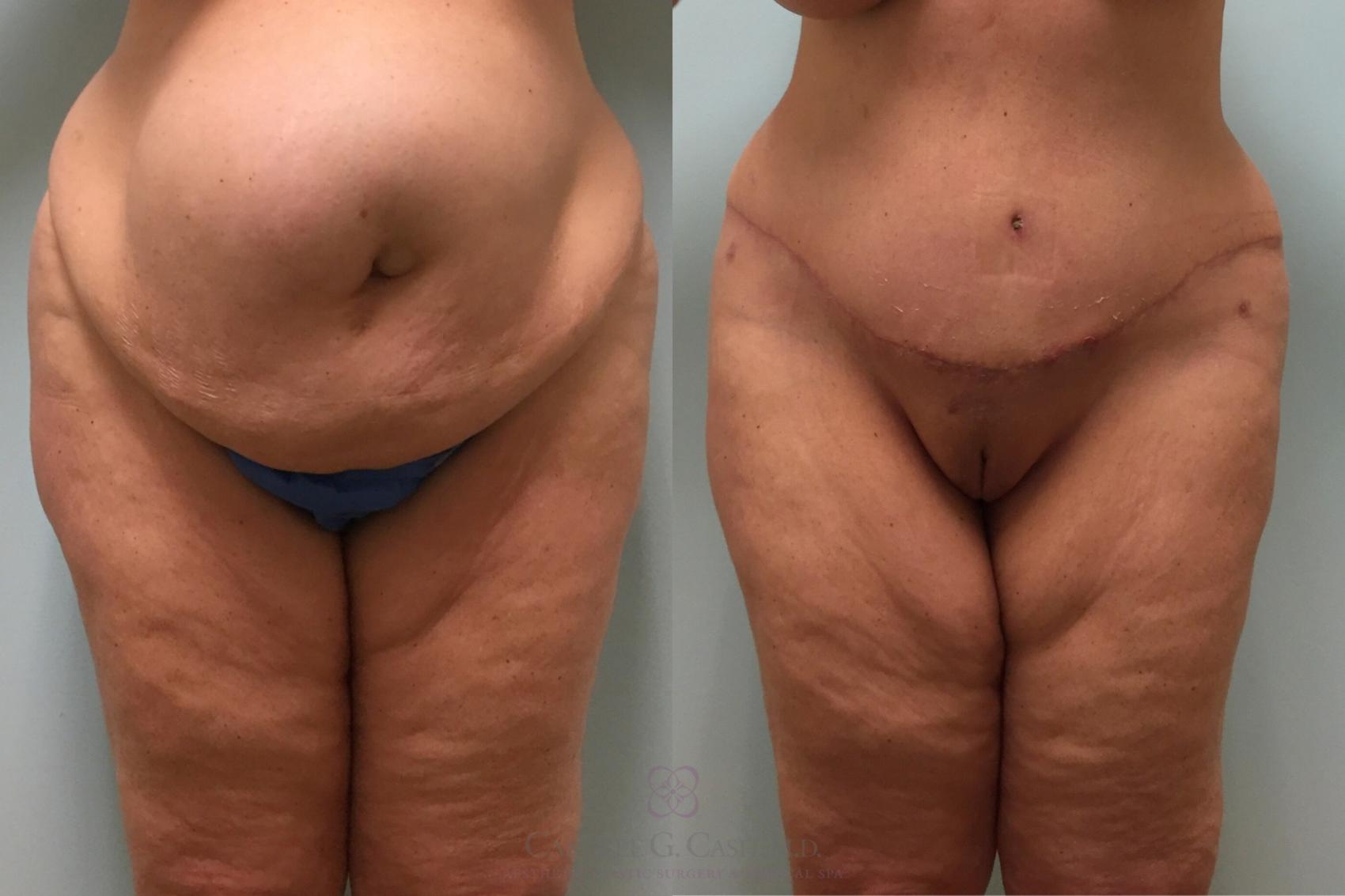 Before & After Tummy Tuck With Hernia Repair Case 253 front 6 weeks View in Houston, TX