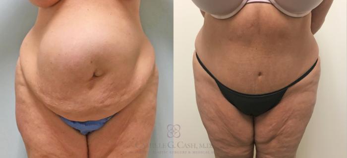 Before & After Tummy Tuck Case 253 Front View in Houston, TX