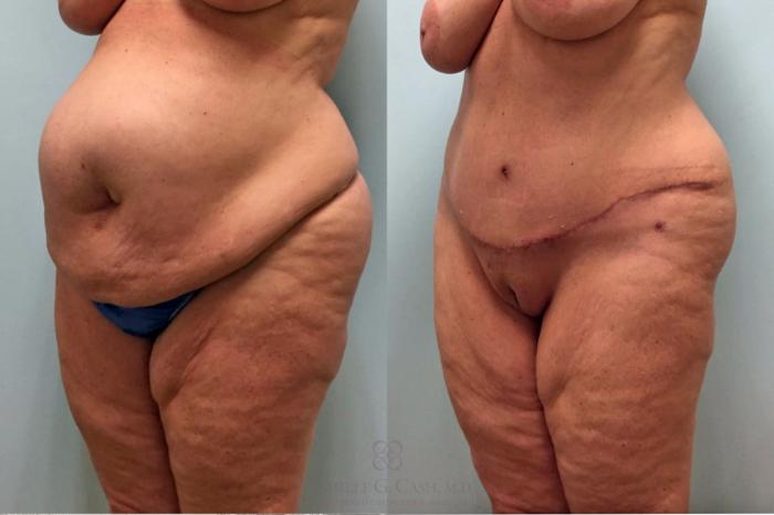 Before & After Tummy Tuck Case 253 Left Oblique View in Houston, TX