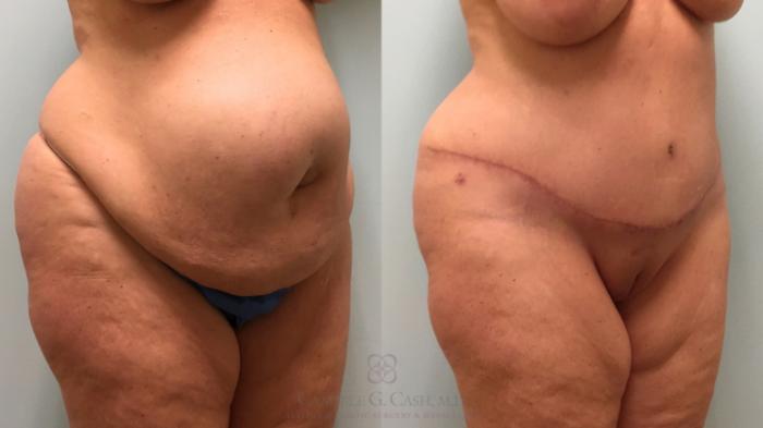Before & After Tummy Tuck Case 253 Right Oblique View in Houston, TX