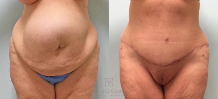 Before & After Tummy Tuck With Hernia Repair Case 253 View #1 View in Houston, TX