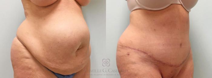 Before & After Tummy Tuck With Hernia Repair Case 253 View #2 View in Houston, TX