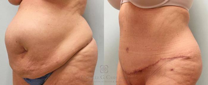Before & After Tummy Tuck With Hernia Repair Case 253 View #3 View in Houston, TX
