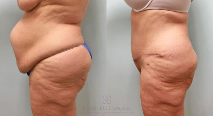 Before & After Tummy Tuck With Hernia Repair Case 253 View #4 View in Houston, TX
