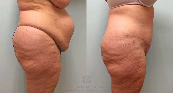 Before & After Tummy Tuck With Hernia Repair Case 253 View #5 View in Houston, TX