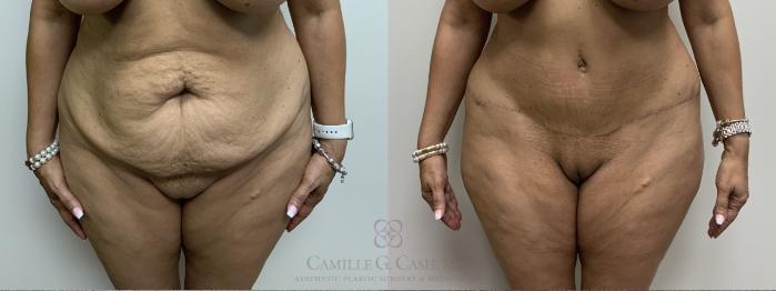 Before & After Tummy Tuck With Hernia Repair Case 661 Front View in Houston, TX