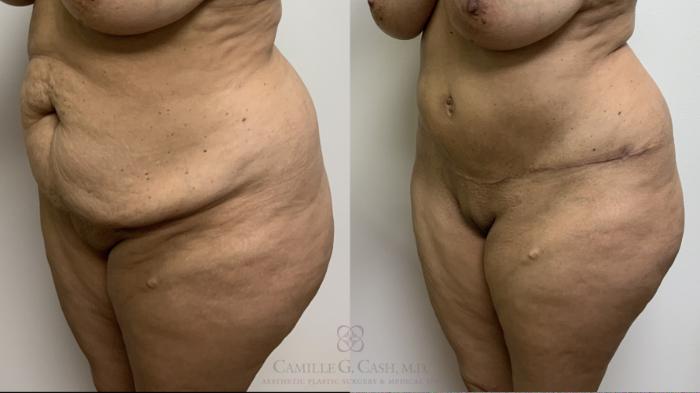 Before & After Tummy Tuck With Hernia Repair Case 661 Left Oblique View in Houston, TX