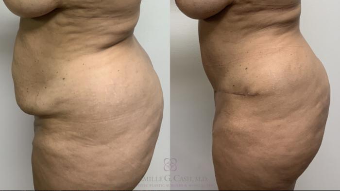 Before & After Tummy Tuck With Hernia Repair Case 661 Left Side View in Houston, TX