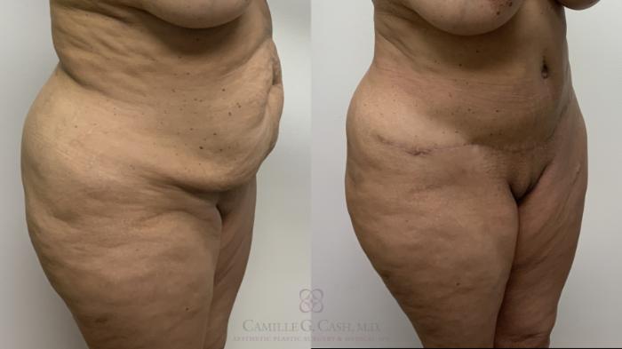 Before & After Tummy Tuck With Hernia Repair Case 661 Right Oblique View in Houston, TX