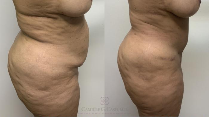 Before & After Tummy Tuck With Hernia Repair Case 661 Right Side View in Houston, TX